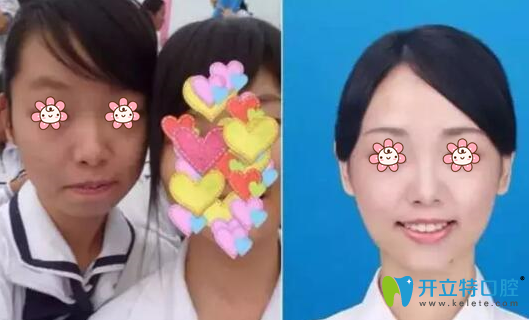 牙齒矯正案例4