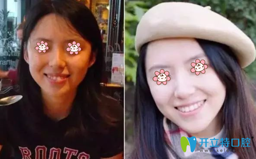 牙齒矯正案例2