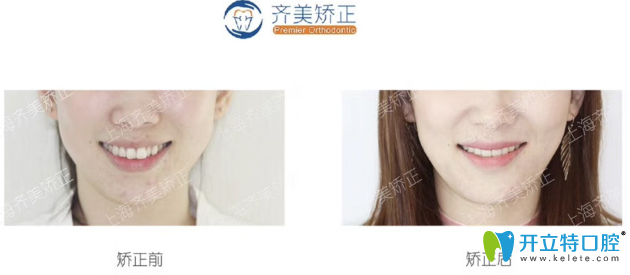 <!--<i data=20240703-sp></i>-->齊美牙齒矯正對比案例
