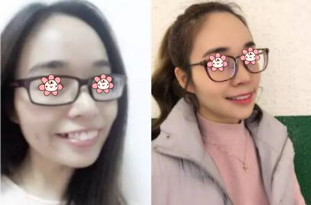 牙齒矯正后悔一輩子真相揭秘，那為什么有人30歲還矯正牙齒