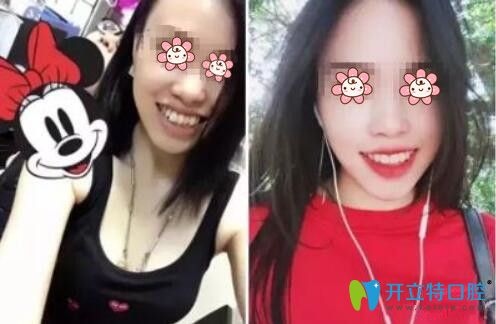 張拓院長牙齒矯正案例