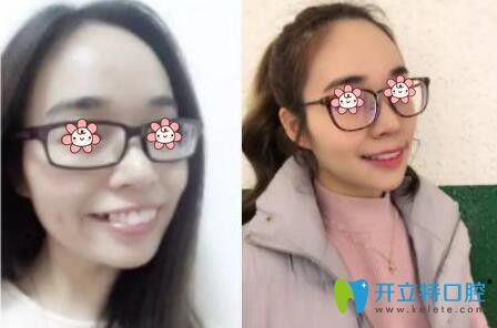 牙齒矯正3