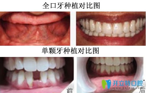 重慶牙博士口腔李榮院長(zhǎng)種植牙案例對(duì)比圖