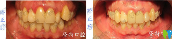 廈門登特口腔羅艷平牙齒矯正效果圖