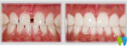 口腔牙齒磨損修復