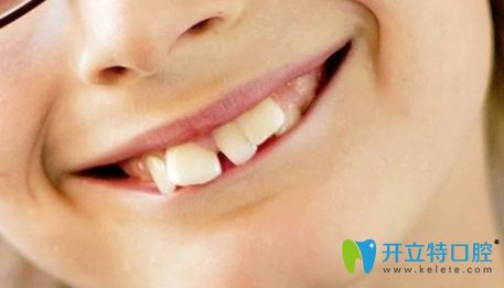 孩子牙齒不好哪個(gè)年齡段整牙好？3M隱形牙套還你整齊牙齒