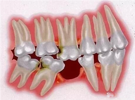 牙齒缺失了 這有三種修復(fù)手段哪種會比較好？