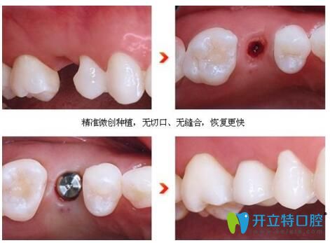 宿遷大眾口腔微創(chuàng)種植牙 安心種植新選擇！