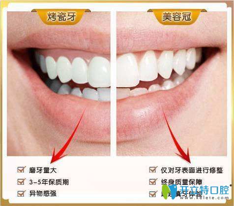 仿生美容冠和烤瓷牙對比 仿生美容冠和烤瓷牙對比