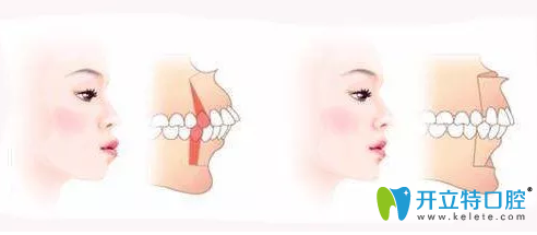 齙牙的情況