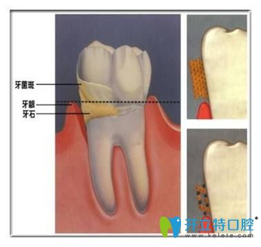 牙結(jié)石的危害你知道嗎？告別牙結(jié)石可以用這7種方法
