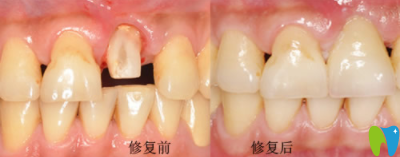 寧波拜博拜爾口腔林玉貴前牙美學(xué)修復(fù)效果圖 寧波拜博拜爾口腔林玉貴前牙美學(xué)修復(fù)效果圖