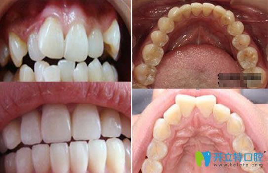 呼市亞非口腔蘇世平牙齒矯正案例