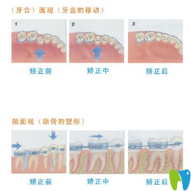 牙齒矯正過程