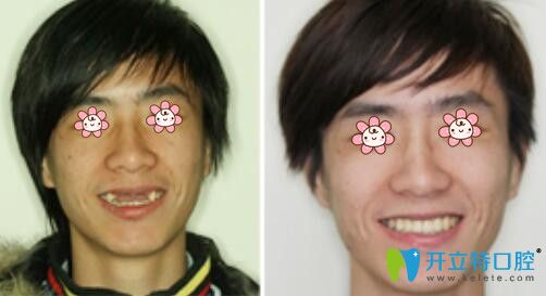 亞歷克斯副院長(zhǎng)牙齒種植案例