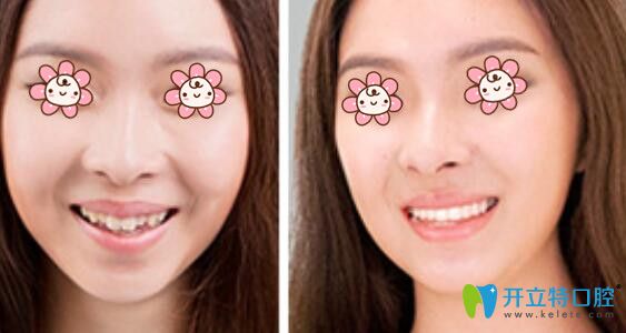 熊修邦副主任牙齒正畸案例