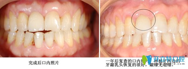 種植牙修復術后案例