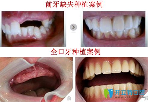 晉中潤芽口腔<!--<i data=20240703-sp></i>-->種植牙好嗎？看<!--<i data=20240703-sp></i>-->種植牙案例對比圖