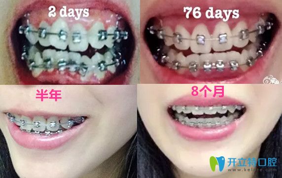 晉中潤(rùn)芽口腔牙齒擁擠矯正變化過(guò)程圖