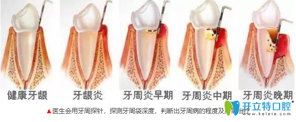 牙周疾病不同階段