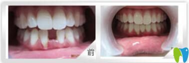 朝陽(yáng)牙博士口腔種植牙讓她恢復(fù)了昔日自信