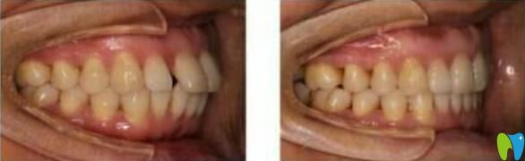 王立安醫(yī)師前牙前凸矯正案例 王立安醫(yī)師前牙前凸矯正案例