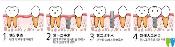 種植牙的手術(shù)方法