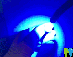 用光源照射引發(fā)牙齒固化