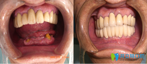 在唐山拜博口腔種植牙前后對比