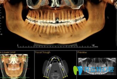 長(zhǎng)沙美萊口腔數(shù)字化矯正專業(yè)軟件分析