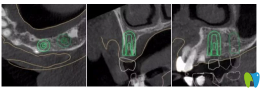 種植牙術(shù)前左上4牙位模擬種植圖