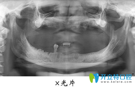 宏沅膛口腔種植牙前X光片