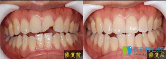 牙齒美學(xué)修復(fù)前后對(duì)比