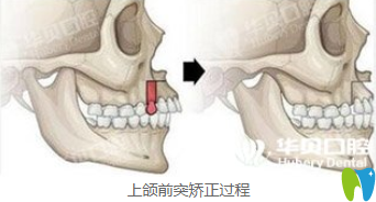 華貝口腔上頜前突矯正過程