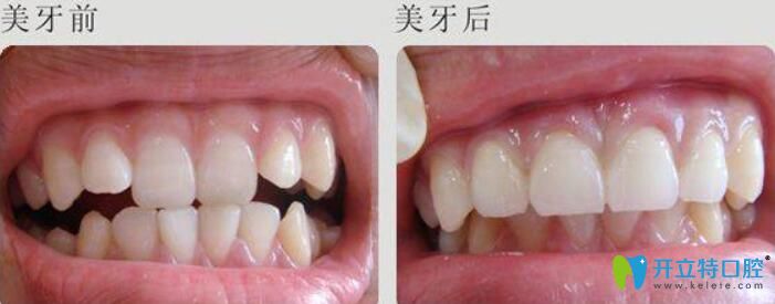 慕林林德國(guó)3D美牙冠案例