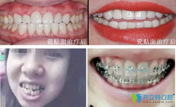愛(ài)德口腔瓷貼面+牙齒矯正效果