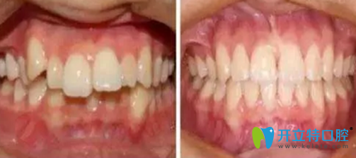 <!--<i data=20240703-sp></i>-->口腔牙齒矯正術(shù)前術(shù)后對比案例