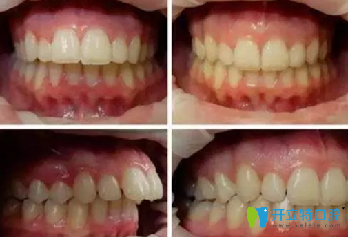 <!--<i data=20240703-sp></i>-->口腔齙牙隱形矯正案例前后對比圖