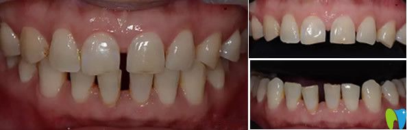 通化愛德口腔牙齒瓷貼面修復(fù)前
