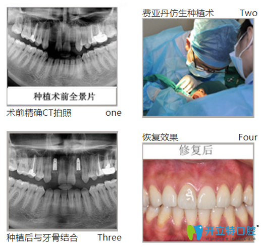 黎強(qiáng)給口牙缺失、牙槽骨萎縮幻陣采用德國(guó)費(fèi)亞丹種植技術(shù)種牙過(guò)程圖