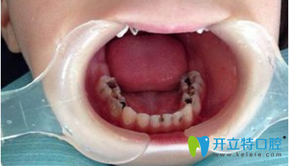 5歲兒童大牙有四顆齲齒要不要補(bǔ) 用3M樹脂材料補(bǔ)牙怎么樣