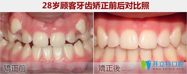 西安小白兔28歲牙齒矯正前后對(duì)比照