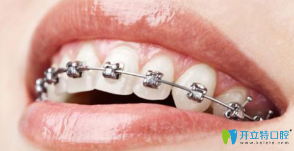 金屬托槽矯正是經(jīng)濟(jì)實(shí)惠的矯正方法