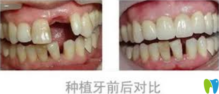 青島可恩口腔種植牙前后效果對比圖