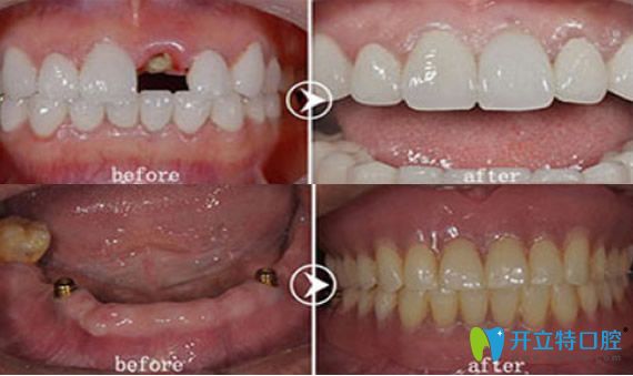 深圳愛康健口腔好不好？愛康健種植牙來證明