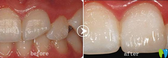 深圳愛康健齒科補(bǔ)牙治療前后對比圖