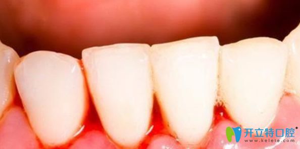 深圳拜博口腔解析：刷牙時(shí)牙齦出血是什么原因該怎么治療
