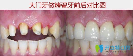 大門牙烤瓷前后對(duì)比圖