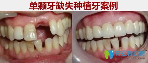 單顆牙缺失種植牙前后對(duì)比效果圖