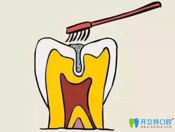 孩子幾歲做窩溝封閉合適？做完窩溝封閉后還會(huì)長蛀牙嗎？